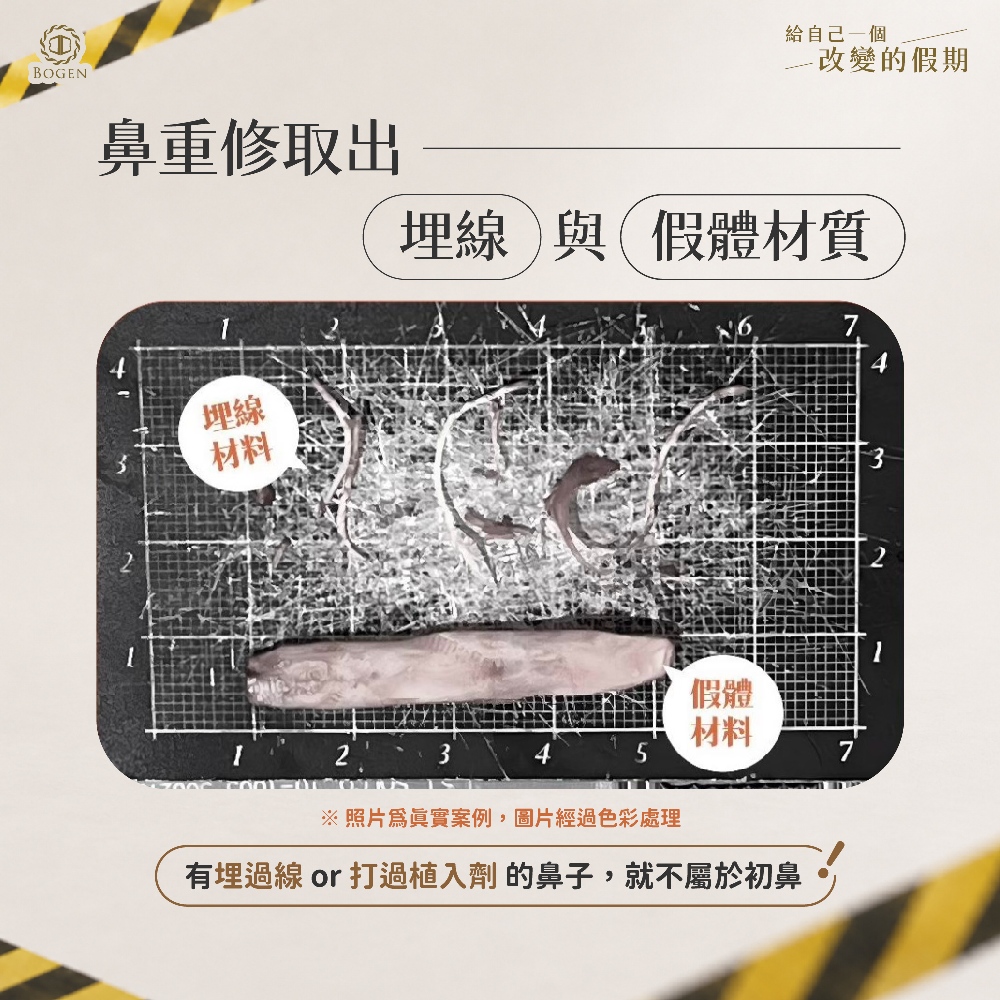 鼻重修取出埋線與假體材質,博恩妍